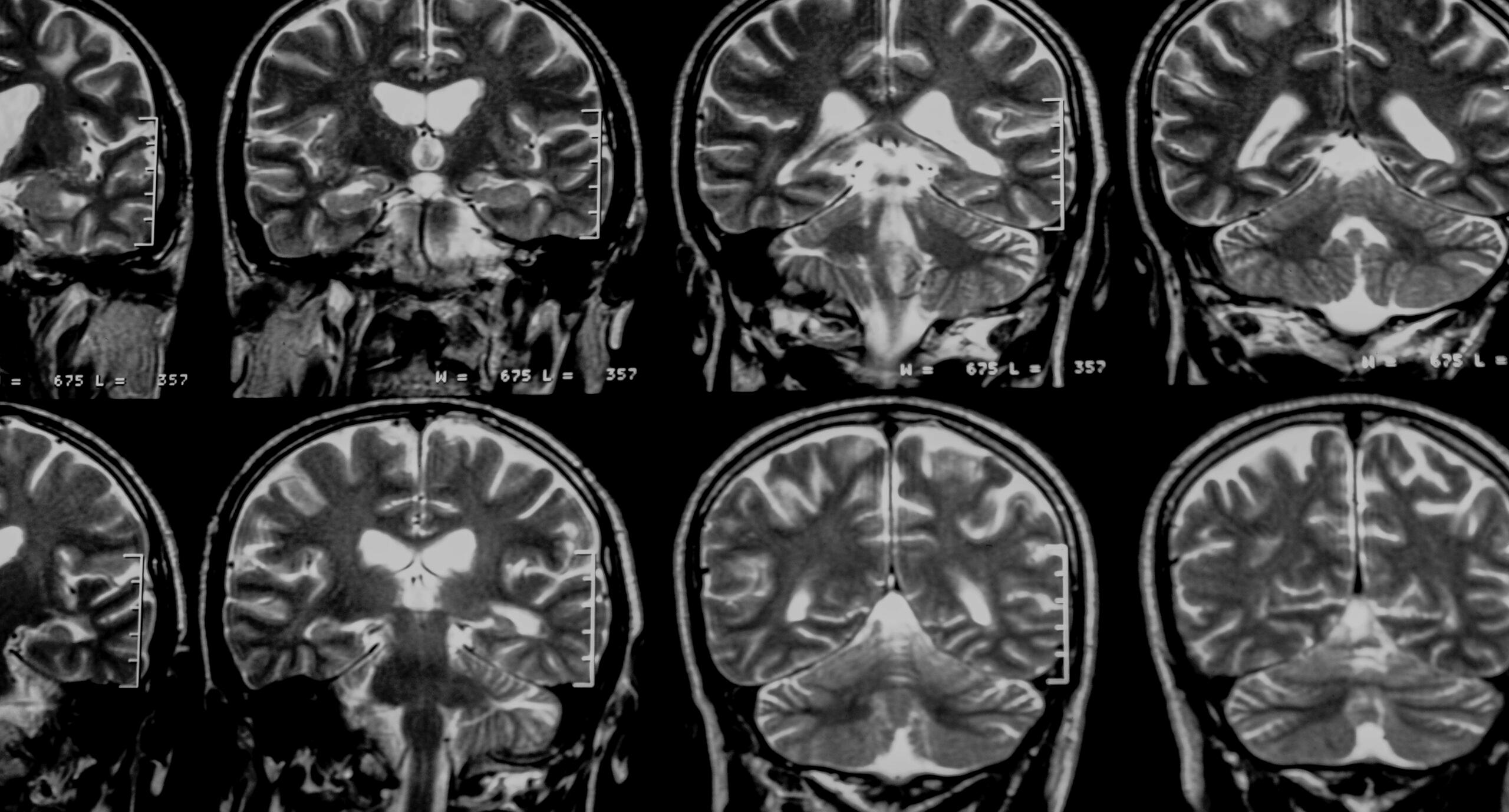 closeup-ct-scan-with-brain-medicine-science-education-mri-brain-background-scaled-e1719940199809-darken